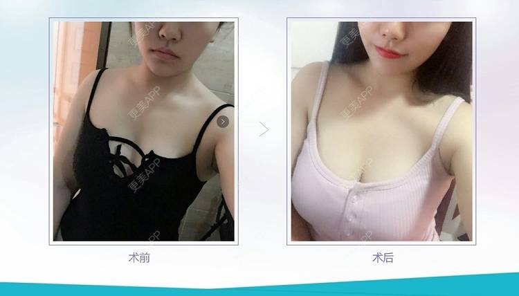 更美 - 成爱落定的乳房再造经验 | 乳房再造 | 美胸套餐 | 成都