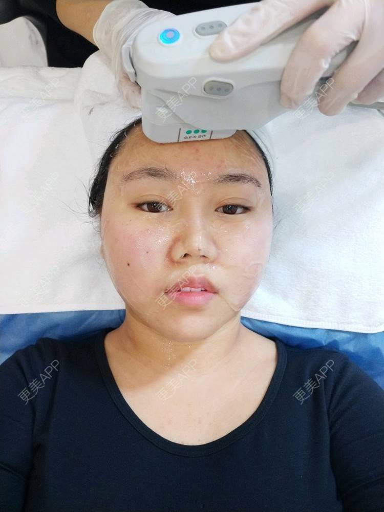 更美 - 素颜de丫的超声提升经验 | 激光紧缩阴道 | 水光项目 | 双眼皮 | 鼻部多项 | 乳头内陷矫正 | 吸脂 | 自体脂肪全面部填充 | 超声提升 | 热拉提 | 除皱瘦脸 | 埋线提升 | 光子嫩肤 | 杭州
