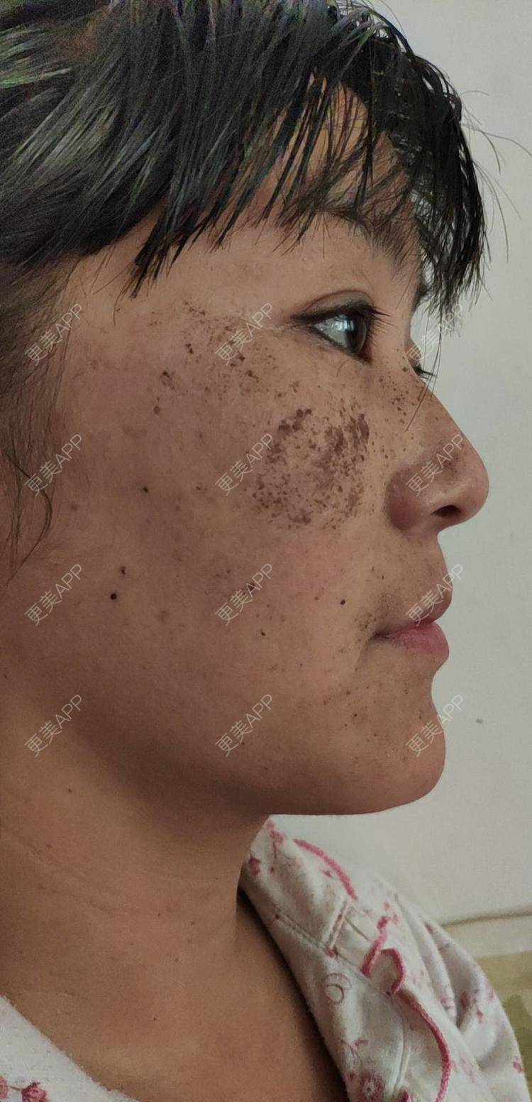 更美 - 更美用户MpZSklUvzO的激光淡斑经验 | 激光淡斑