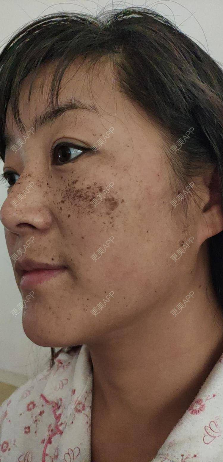 更美 - 更美用户MpZSklUvzO的激光淡斑经验 | 激光淡斑