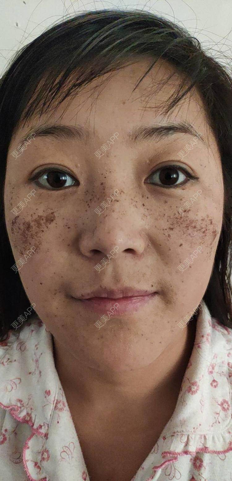 更美 - 更美用户MpZSklUvzO的激光淡斑经验 | 激光淡斑