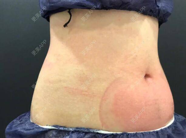 更美 - 不能喝酒的冷冻溶脂日记 | 冷冻溶脂