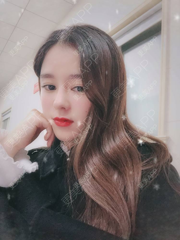 更美 - 更美用户5xHgNpMoLr的鼻部膨体假体取出经验 | 杭州 | 鼻部膨体假体取出 | 视频日记