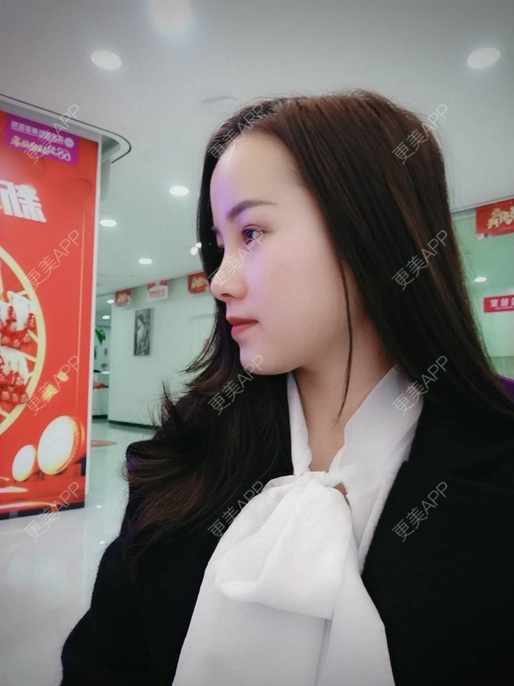 更美 - 米连菊 医生的玻尿酸鼻部经验 | 广州 | 玻尿酸鼻部