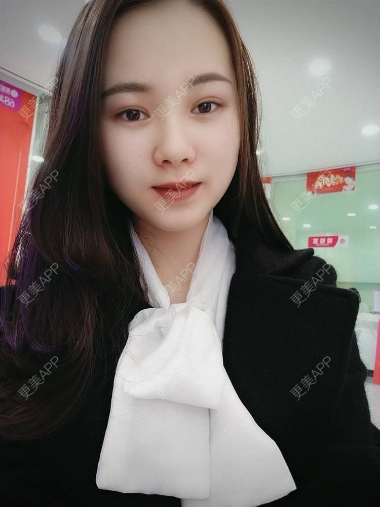 更美 - 米连菊 医生的玻尿酸鼻部经验 | 广州 | 玻尿酸鼻部
