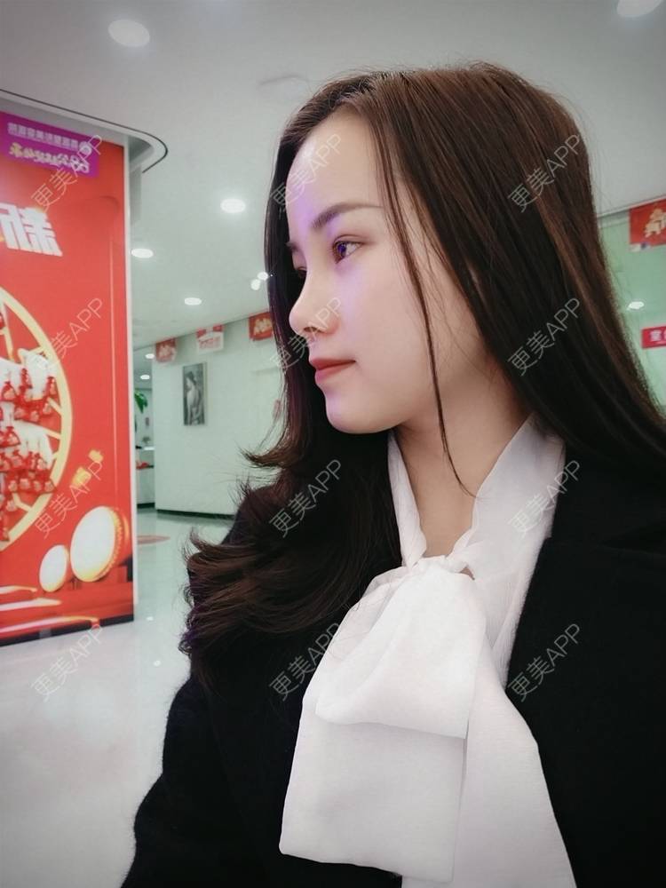 更美 - 米连菊 医生的玻尿酸鼻部经验 | 广州 | 玻尿酸鼻部