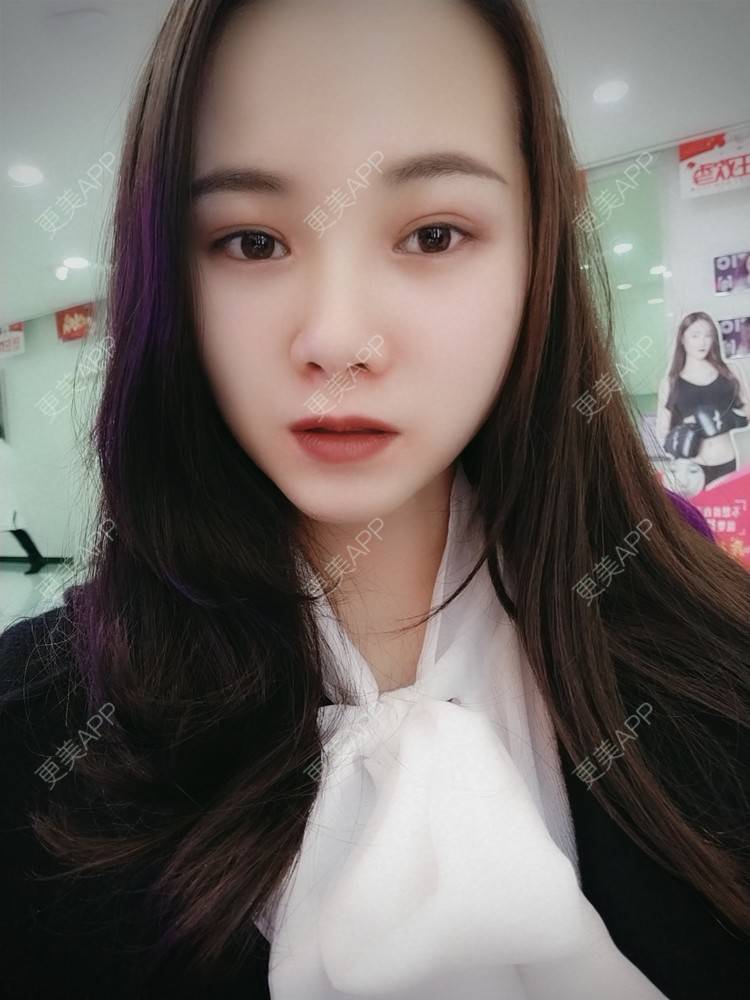 更美 - 米连菊 医生的玻尿酸鼻部经验 | 广州 | 玻尿酸鼻部