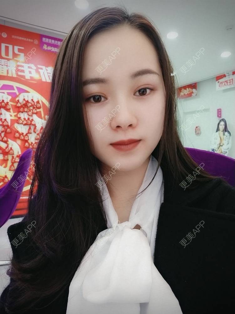 更美 - 米连菊 医生的玻尿酸鼻部经验 | 广州 | 玻尿酸鼻部