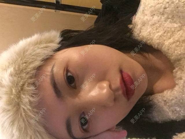 更美 - guuuu的玻尿酸经验 | M唇成形 | 吸脂瘦脸 | 泉州 | 重庆 | 超声提升 | 舒敏之星 | 水光项目 | 昆明 | 眼部多项 | 双眼皮 | 上海 | 鼻部综合 | 热玛吉 | 杭州 | 广州 | 玻尿酸 | 埋线隆鼻 | 吸脂 | 隆鼻