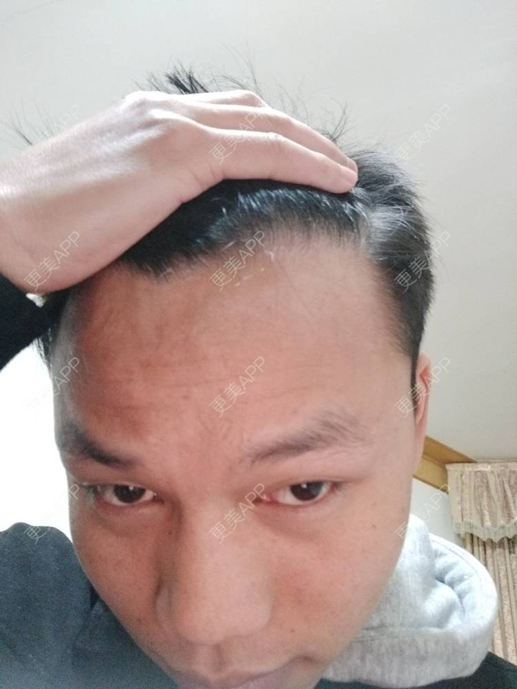 更美用户x0etcvlvji的植发际线日记