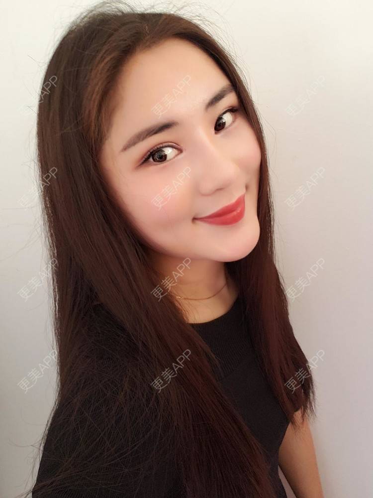 更美 - 更美用户va9l4ethss的膨体隆鼻日记 | 膨体隆鼻 | 鼻综合