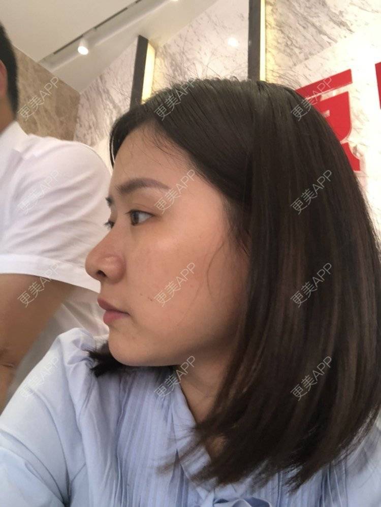 更美 - 欧巴桑💋🙈🤒🤒的鼻中隔软骨隆鼻经验 | 鼻中隔软骨隆鼻 | 重庆