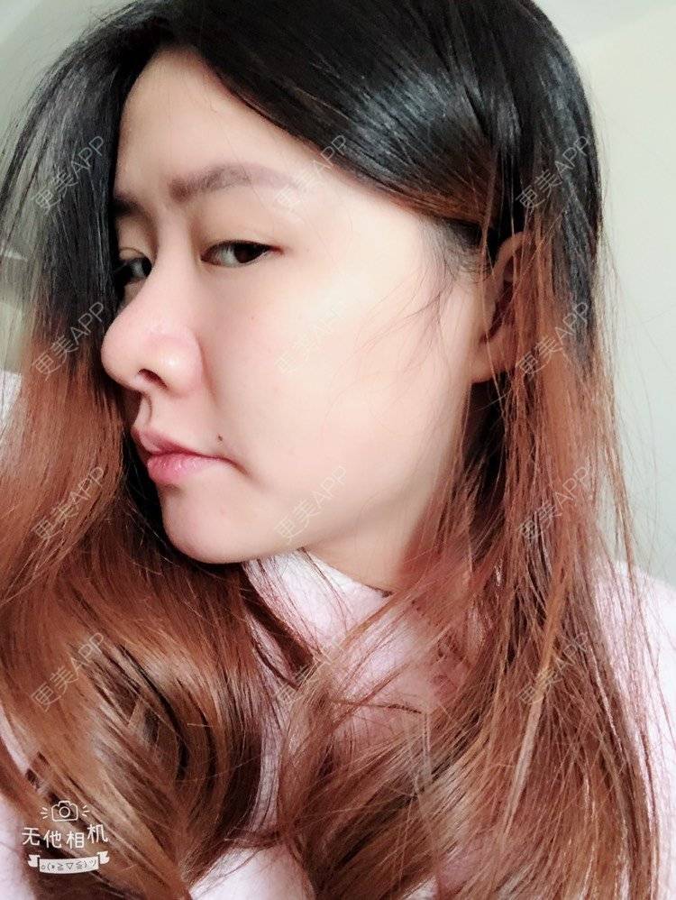 更美 - 欧巴桑💋🙈🤒🤒的鼻中隔软骨隆鼻经验 | 鼻中隔软骨隆鼻 | 重庆