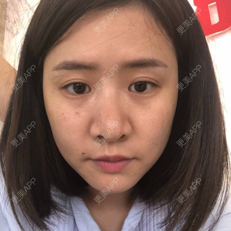 更美 - 欧巴桑💋🙈🤒🤒的鼻中隔软骨隆鼻经验 | 鼻中隔软骨隆鼻 | 重庆