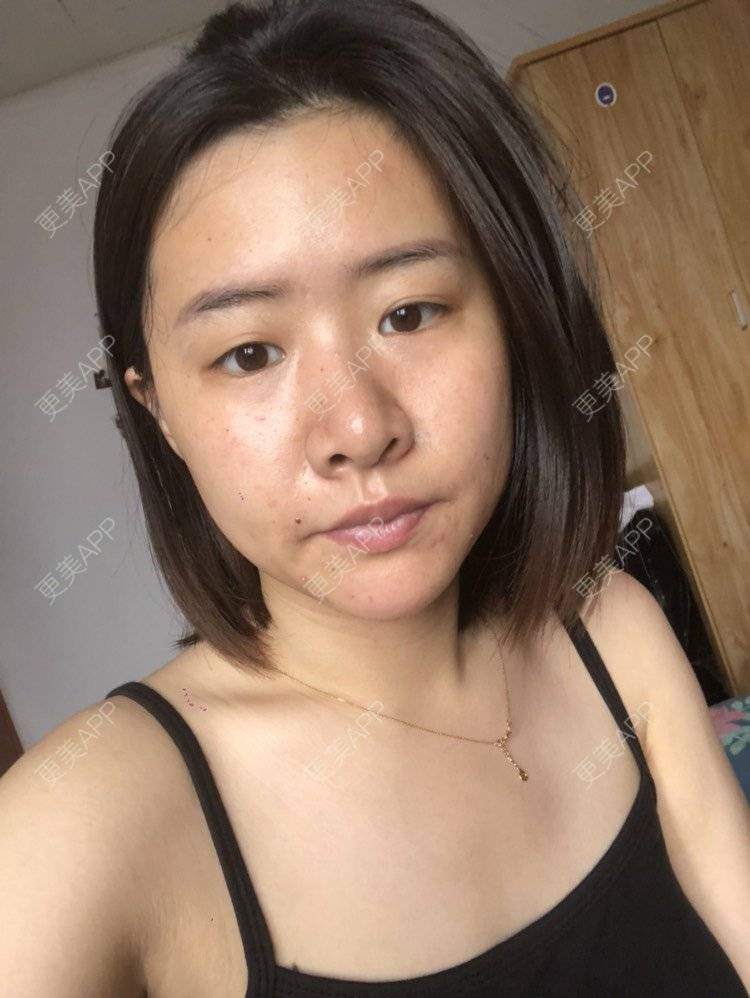 更美 - 欧巴桑💋🙈🤒🤒的鼻中隔软骨隆鼻经验 | 鼻中隔软骨隆鼻 | 重庆
