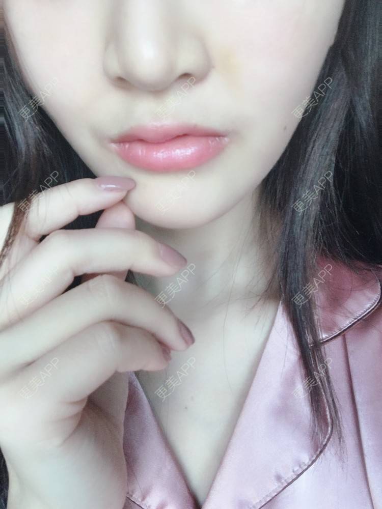 更美 - 熊熊熊大的玻尿酸唇部日记 | m唇成形 | 厚唇改薄 | 玻尿酸唇