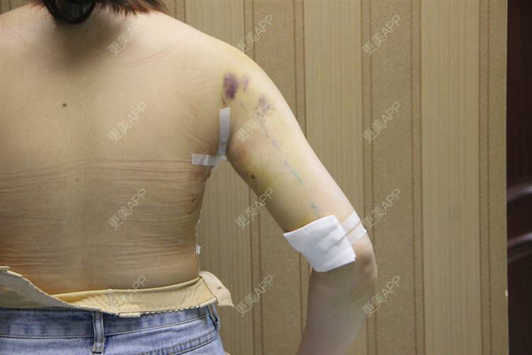 更美用户ll6ao2vnfo的手臂吸脂日记