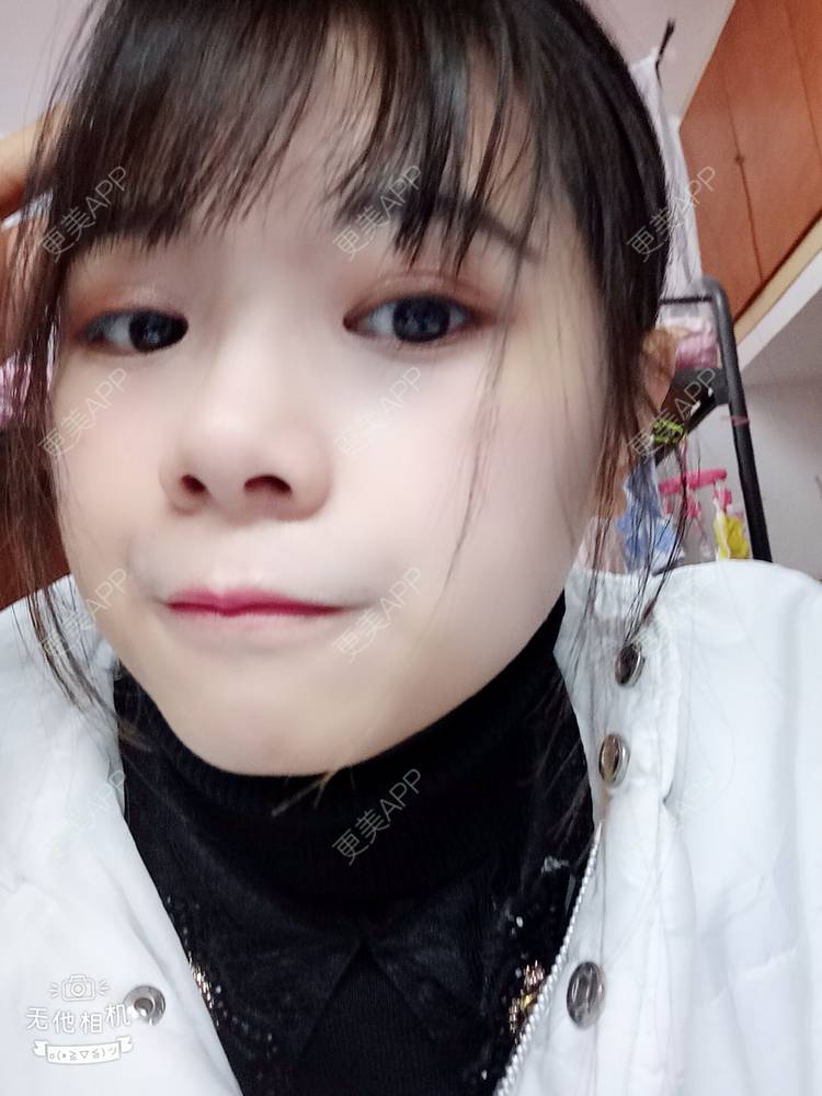 更美 - 更美用户2xAqCgwVY0的内切去眼袋经验 | 内切去眼袋 | 武汉