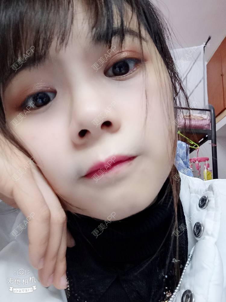 更美 - 更美用户2xAqCgwVY0的内切去眼袋经验 | 内切去眼袋 | 武汉