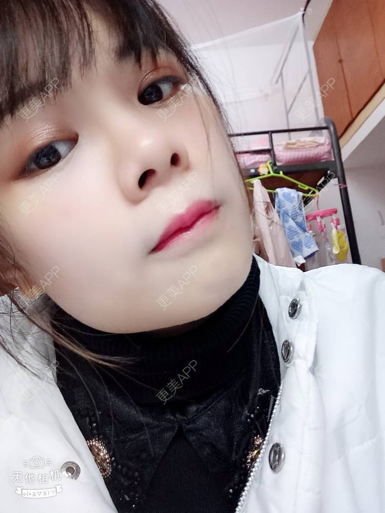 更美 - 更美用户2xAqCgwVY0的内切去眼袋经验 | 内切去眼袋 | 武汉