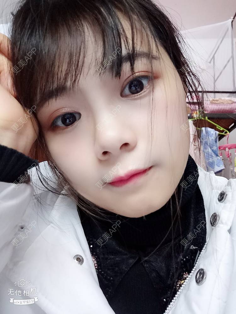 更美 - 更美用户2xAqCgwVY0的内切去眼袋经验 | 内切去眼袋 | 武汉