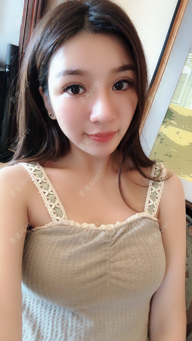 更美用户xrxdcoz5lc的自体脂肪隆胸日记