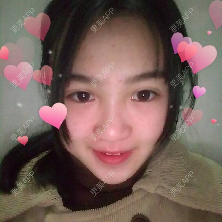 更美 - 更美用户wbJan4VHp8的眼皮下垂矫正经验 | 长沙 | 眼皮下垂矫正