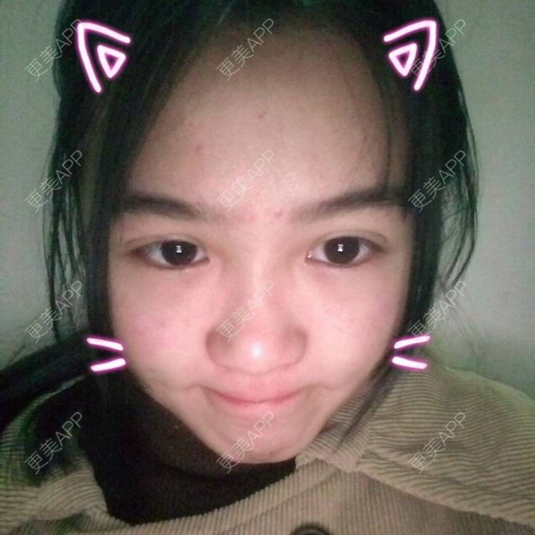 更美 - 更美用户wbJan4VHp8的眼皮下垂矫正经验 | 长沙 | 眼皮下垂矫正