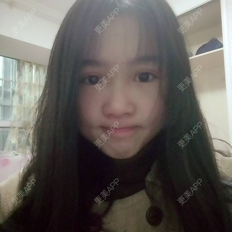 更美 - 更美用户wbJan4VHp8的眼皮下垂矫正经验 | 长沙 | 眼皮下垂矫正