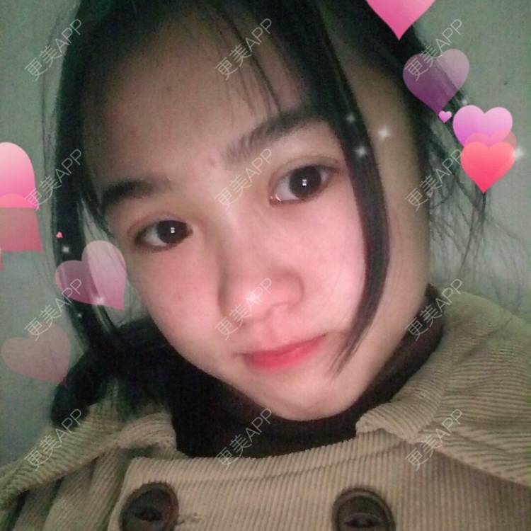 更美 - 更美用户wbJan4VHp8的眼皮下垂矫正经验 | 长沙 | 眼皮下垂矫正