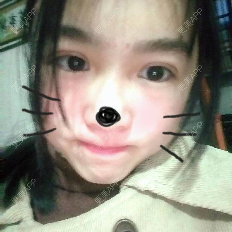 更美 - 更美用户wbJan4VHp8的眼皮下垂矫正经验 | 长沙 | 眼皮下垂矫正