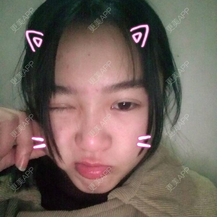 更美 - 更美用户wbJan4VHp8的眼皮下垂矫正经验 | 长沙 | 眼皮下垂矫正