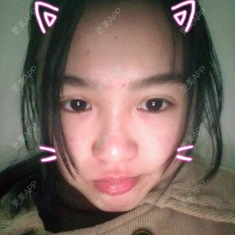 更美 - 更美用户wbJan4VHp8的眼皮下垂矫正经验 | 长沙 | 眼皮下垂矫正