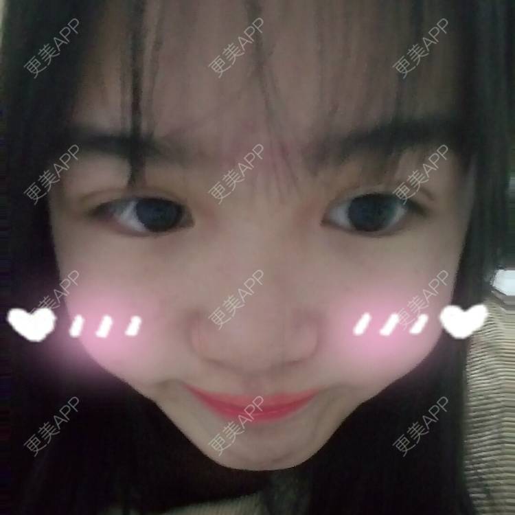 更美 - 更美用户wbJan4VHp8的眼皮下垂矫正经验 | 长沙 | 眼皮下垂矫正