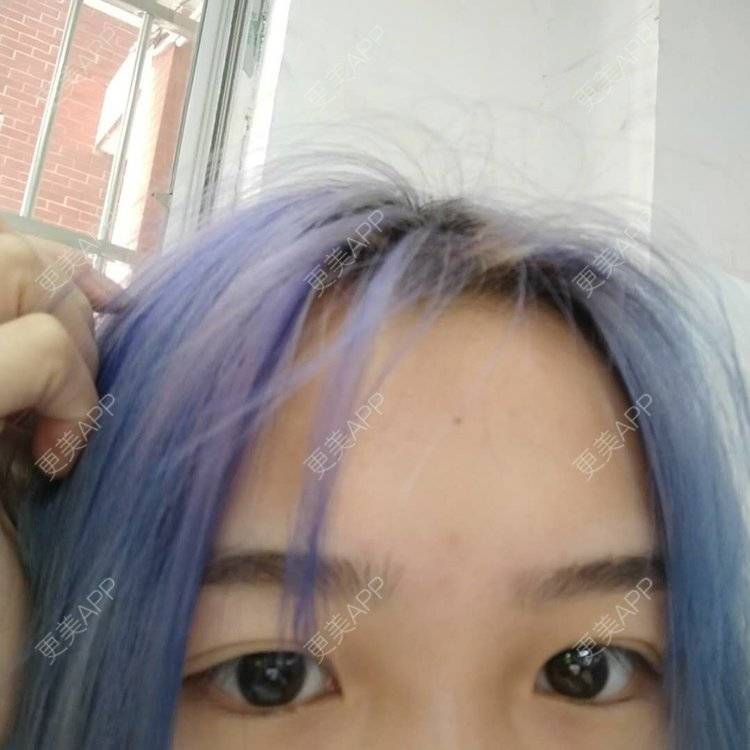 更美 - 更美用户wbJan4VHp8的眼皮下垂矫正经验 | 长沙 | 眼皮下垂矫正
