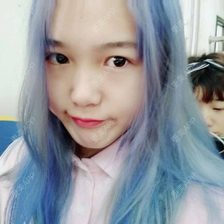 更美 - 更美用户wbJan4VHp8的眼皮下垂矫正经验 | 长沙 | 眼皮下垂矫正