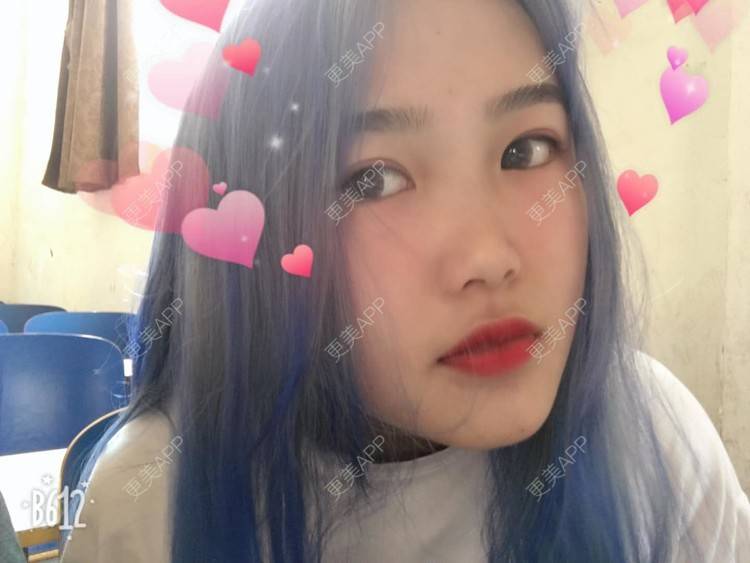 更美 - 更美用户wbJan4VHp8的眼皮下垂矫正经验 | 长沙 | 眼皮下垂矫正