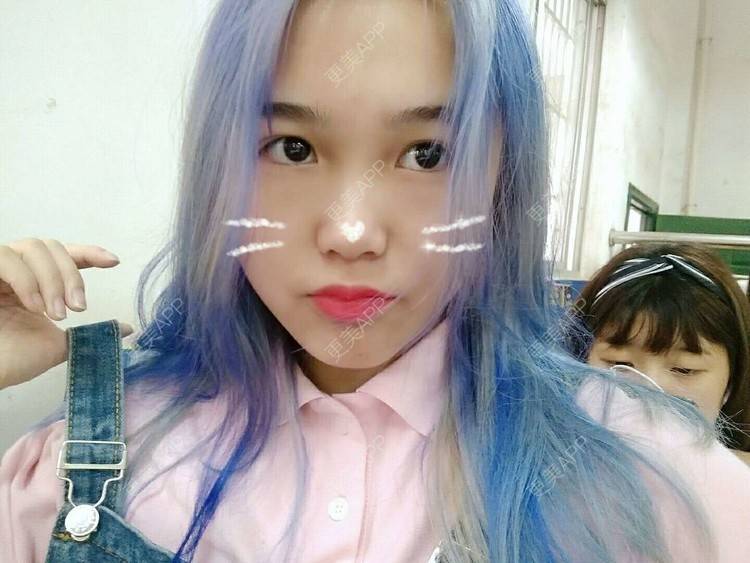 更美 - 更美用户wbJan4VHp8的眼皮下垂矫正经验 | 长沙 | 眼皮下垂矫正