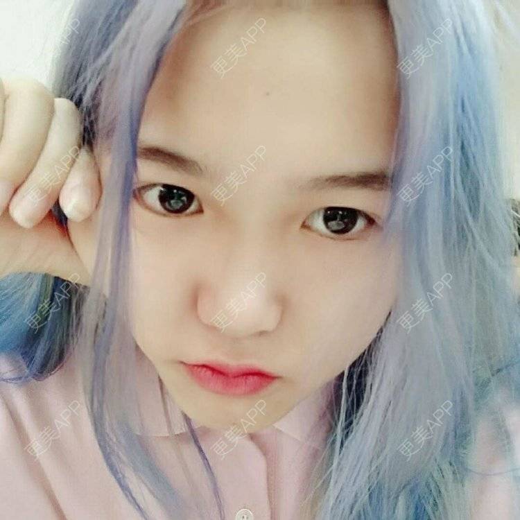 更美 - 更美用户wbJan4VHp8的眼皮下垂矫正经验 | 长沙 | 眼皮下垂矫正