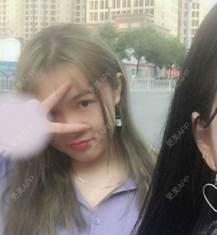 更美 - 更美用户wbJan4VHp8的眼皮下垂矫正经验 | 长沙 | 眼皮下垂矫正