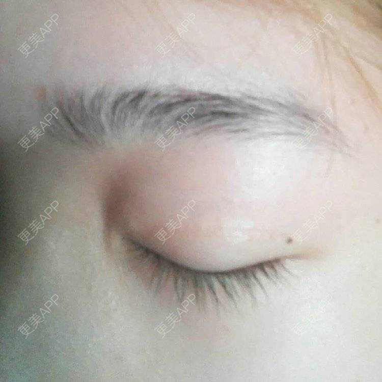 更美 - 更美用户wbJan4VHp8的眼皮下垂矫正经验 | 长沙 | 眼皮下垂矫正