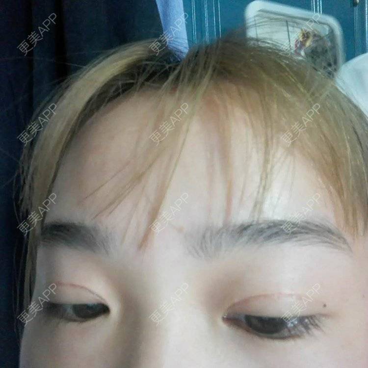 更美 - 更美用户wbJan4VHp8的眼皮下垂矫正经验 | 长沙 | 眼皮下垂矫正