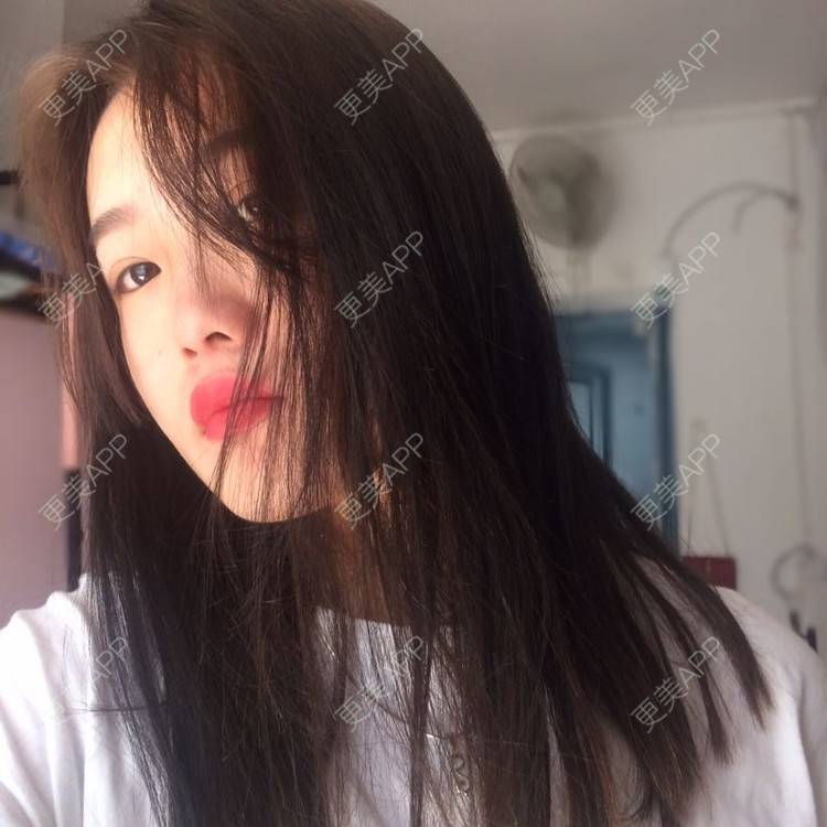更美 - 更美用户wbJan4VHp8的眼皮下垂矫正经验 | 长沙 | 眼皮下垂矫正