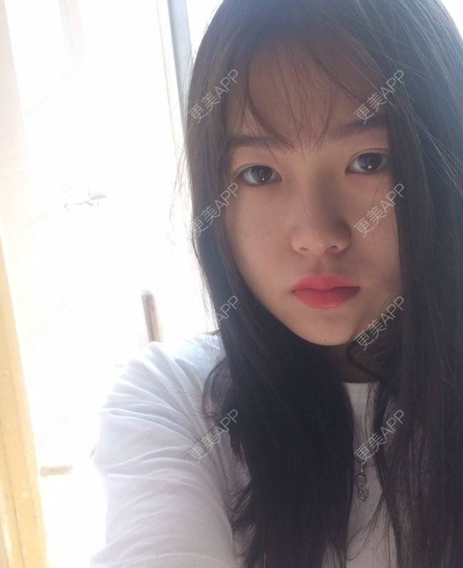 更美 - 更美用户wbJan4VHp8的眼皮下垂矫正经验 | 长沙 | 眼皮下垂矫正