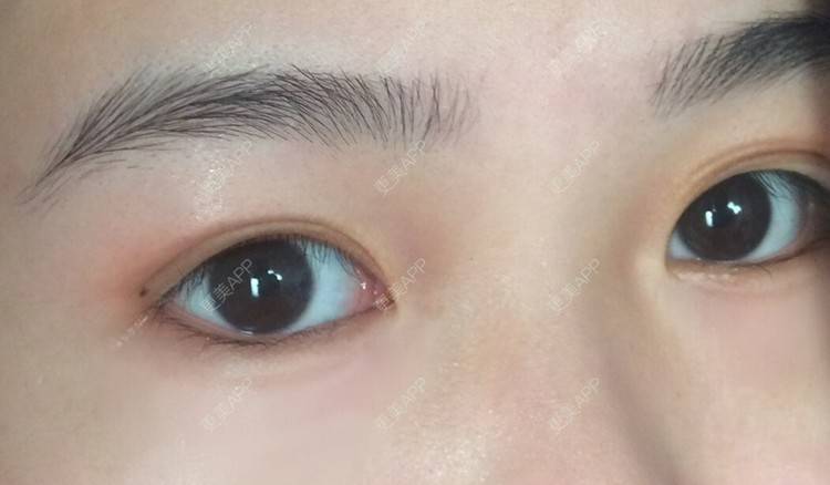 更美 - 更美用户wbJan4VHp8的眼皮下垂矫正经验 | 长沙 | 眼皮下垂矫正