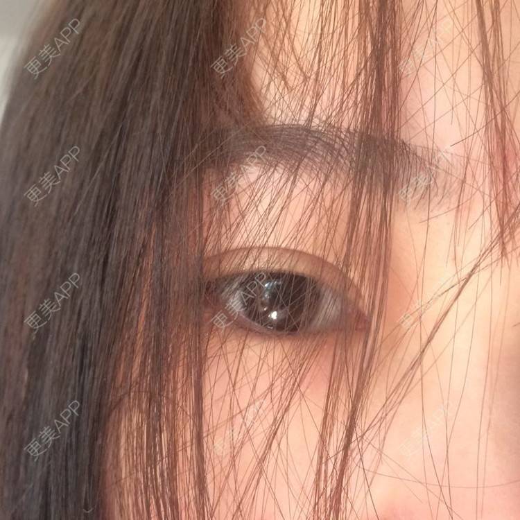 更美 - 更美用户wbJan4VHp8的眼皮下垂矫正经验 | 长沙 | 眼皮下垂矫正