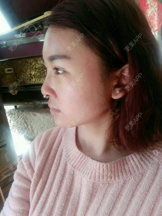 更美 - 金木研CP的全切双眼皮经验 | 全切双眼皮 | 昆明