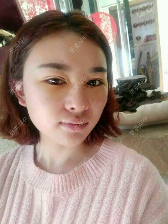 更美 - 金木研CP的全切双眼皮经验 | 全切双眼皮 | 昆明