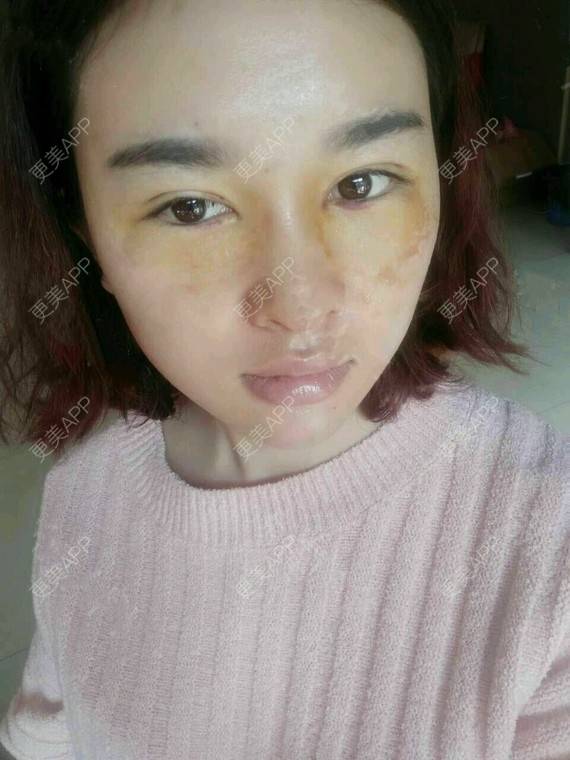 更美 - 金木研CP的全切双眼皮经验 | 全切双眼皮 | 昆明