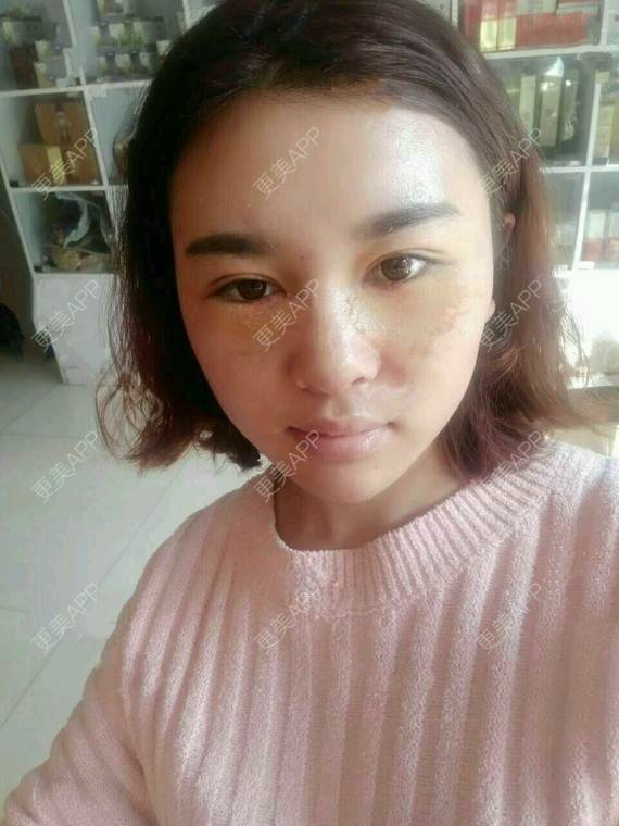 更美 - 金木研CP的全切双眼皮经验 | 全切双眼皮 | 昆明